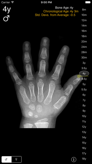 Bone Age